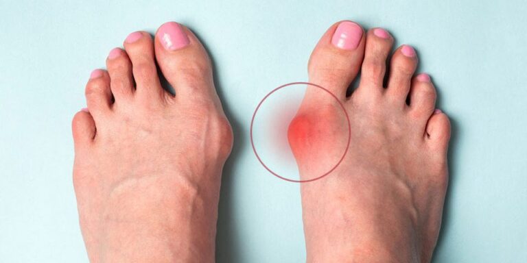 Hallux valgus یا “پیش‌پاچپچک”